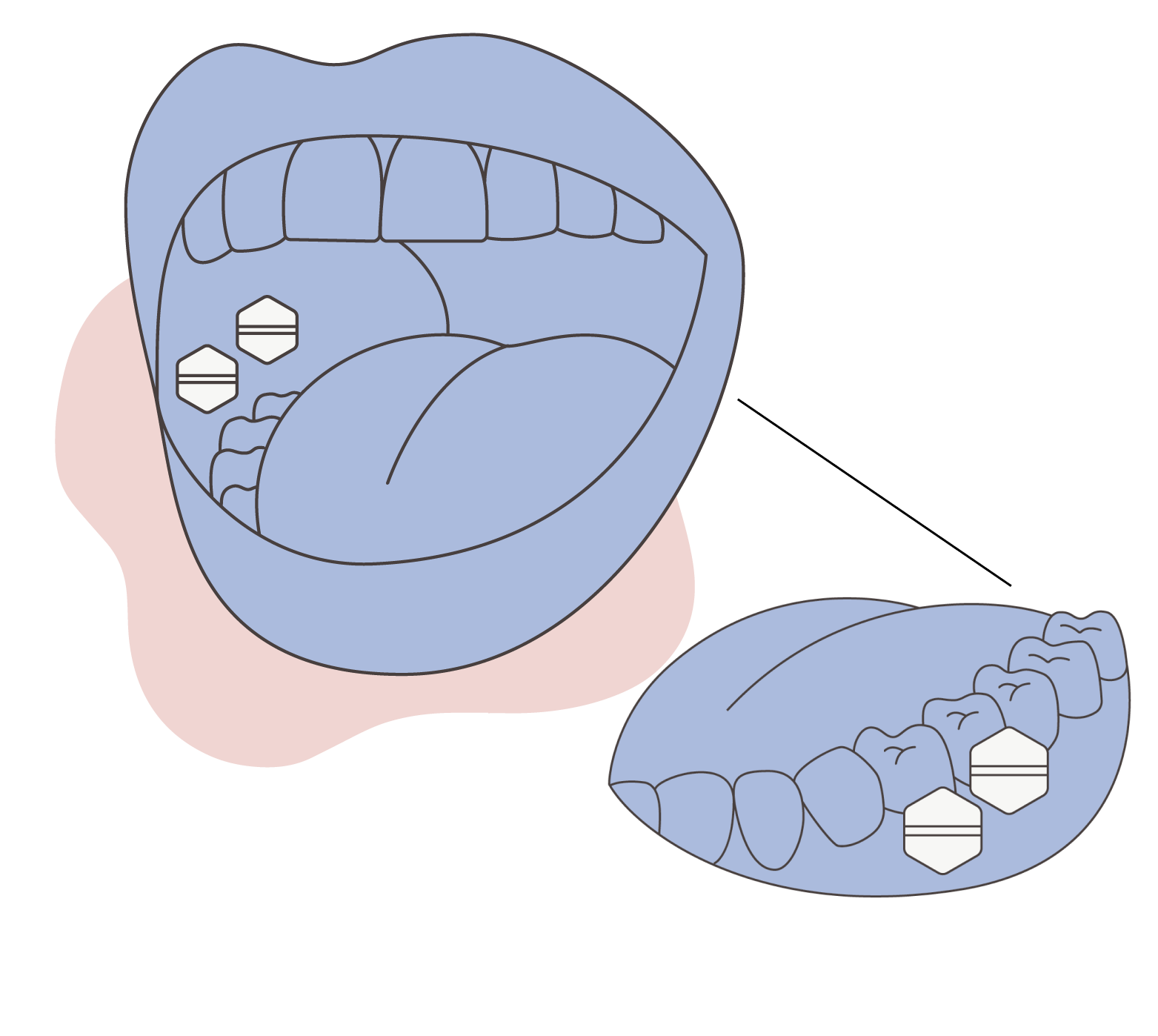 Illustration of buccal administration of misoprostol